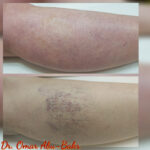 Photo Gallery - Varicose Vein Clinic & Consultation | The Veins Doctor