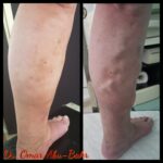 Photo Gallery - Varicose Vein Clinic & Consultation | The Veins Doctor