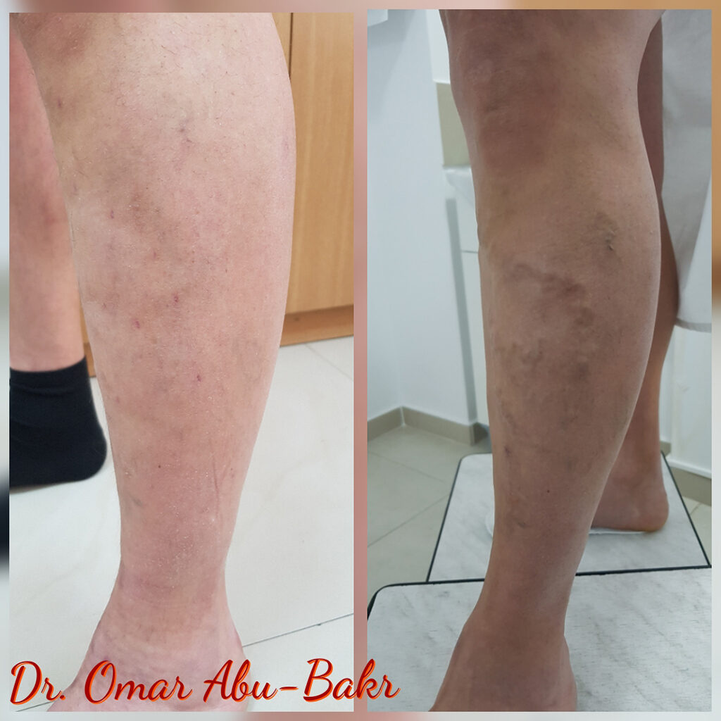 varicose veins treatment before and after