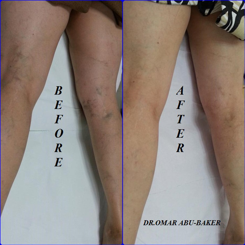 spider and varicose veins treatment before and after