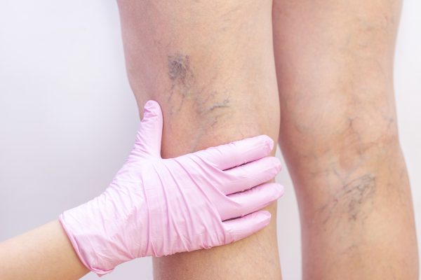 Common Symptoms of Varicose Veins: When to Seek Treatment